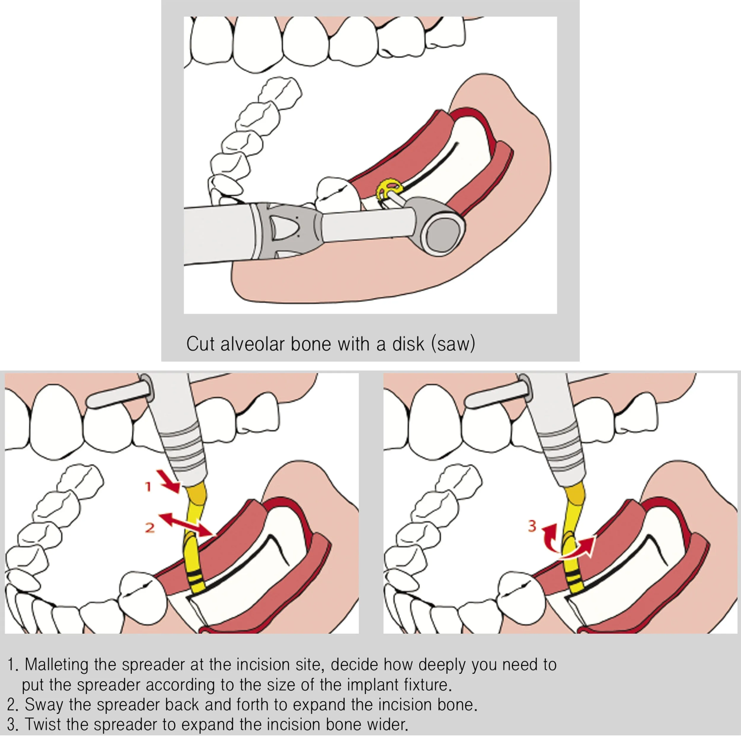 Bone Spreader 2.2mm Premium Osung -BOC22